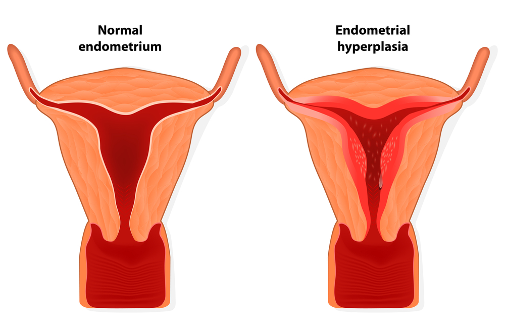 Menorrhagia Menstrual Disorder In Women ReliableRxPharmacy Blog 