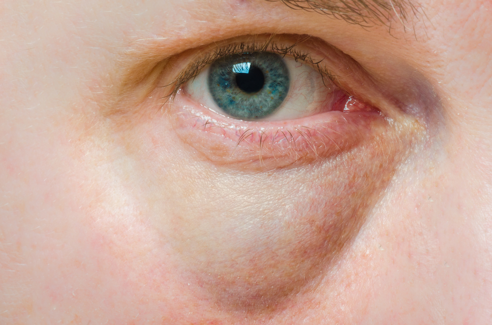 easy-remedies-to-get-rid-of-puffy-eyes-reliablerxpharmacy-blog