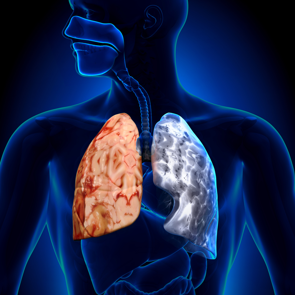 Differences Between COPD And Asthma – ReliableRxPharmacy Blog, Health Blog