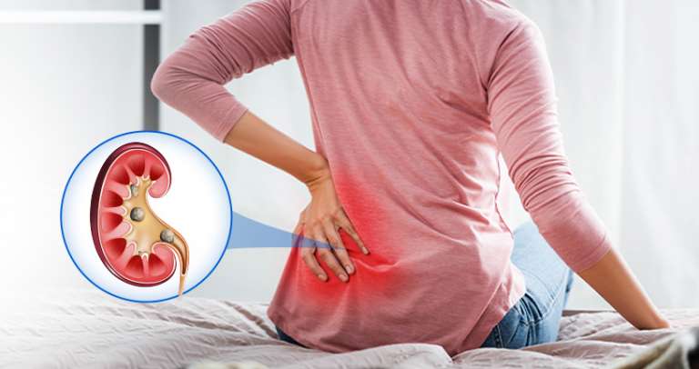 Can Kidney Stones Ever Affect the Kidney Function? - ReliableRxPharmacy ...