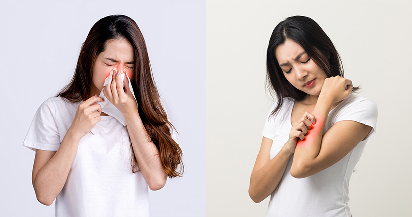 Allergies, its type and Treatment