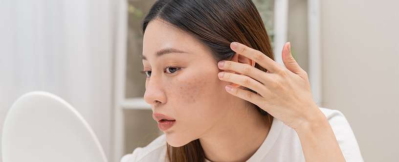 Skincare Routine for Melasma